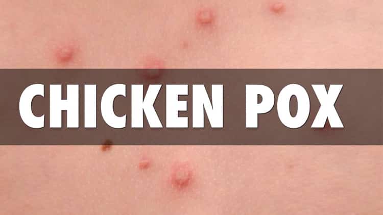 All About Chickenpox: How to Identify, Treat and Avoid It