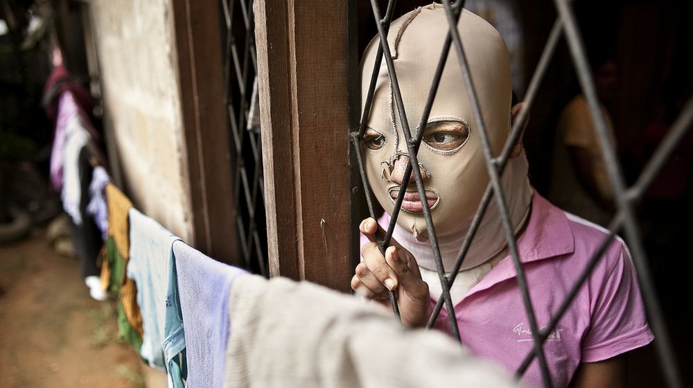 victim of acid attack