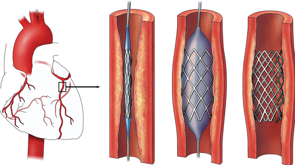 Pakistan to Locally Produce International Standard Cardiac Stents for 1/4th The Price
