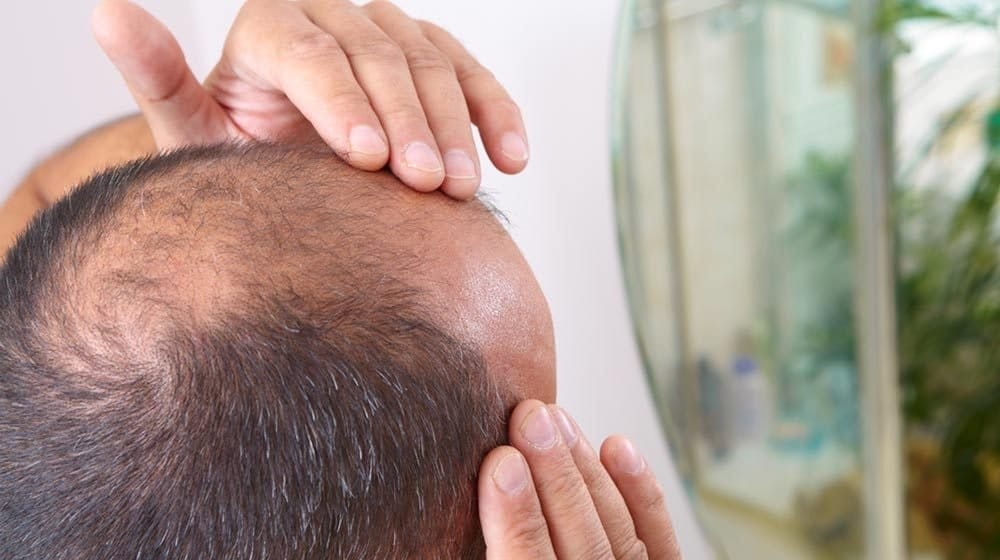 new research for baldness