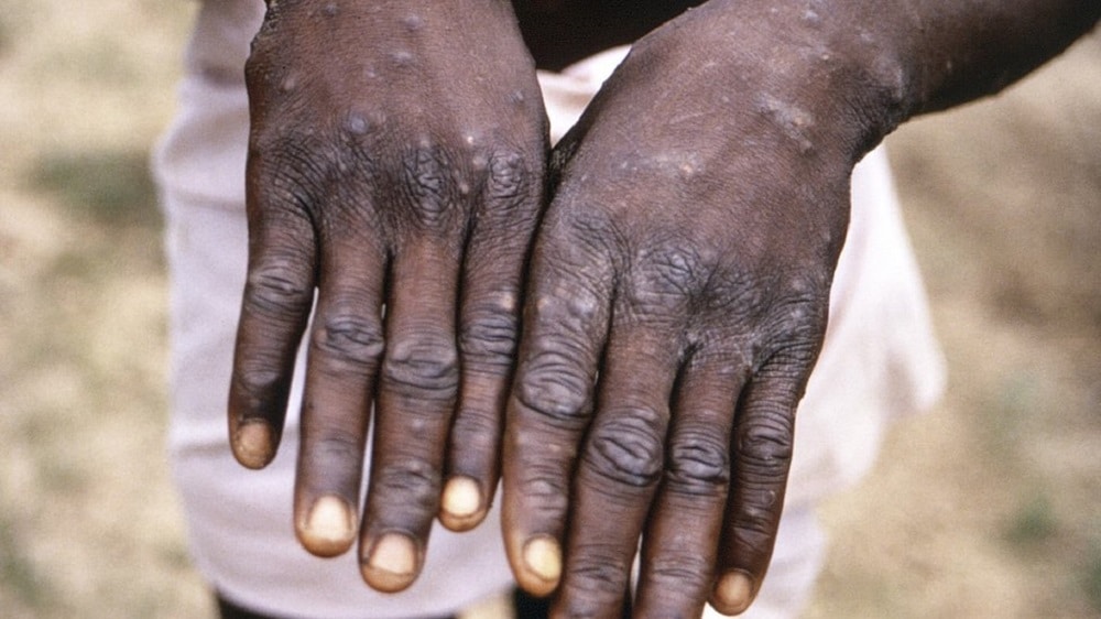 All You Need to Know as World Reports Cases of Rare Monkeypox Virus
