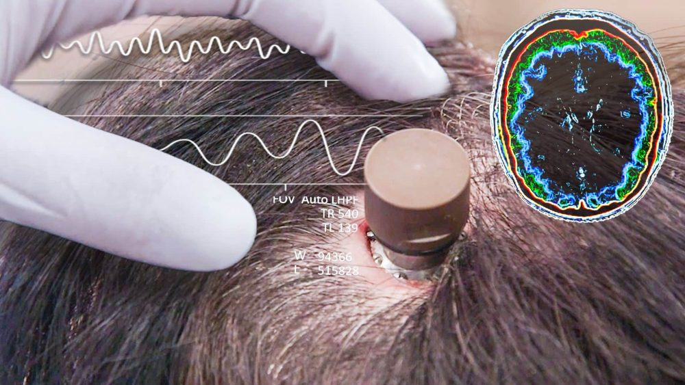 Elon Musk to Start Putting Chips in Human Brains Very Soon