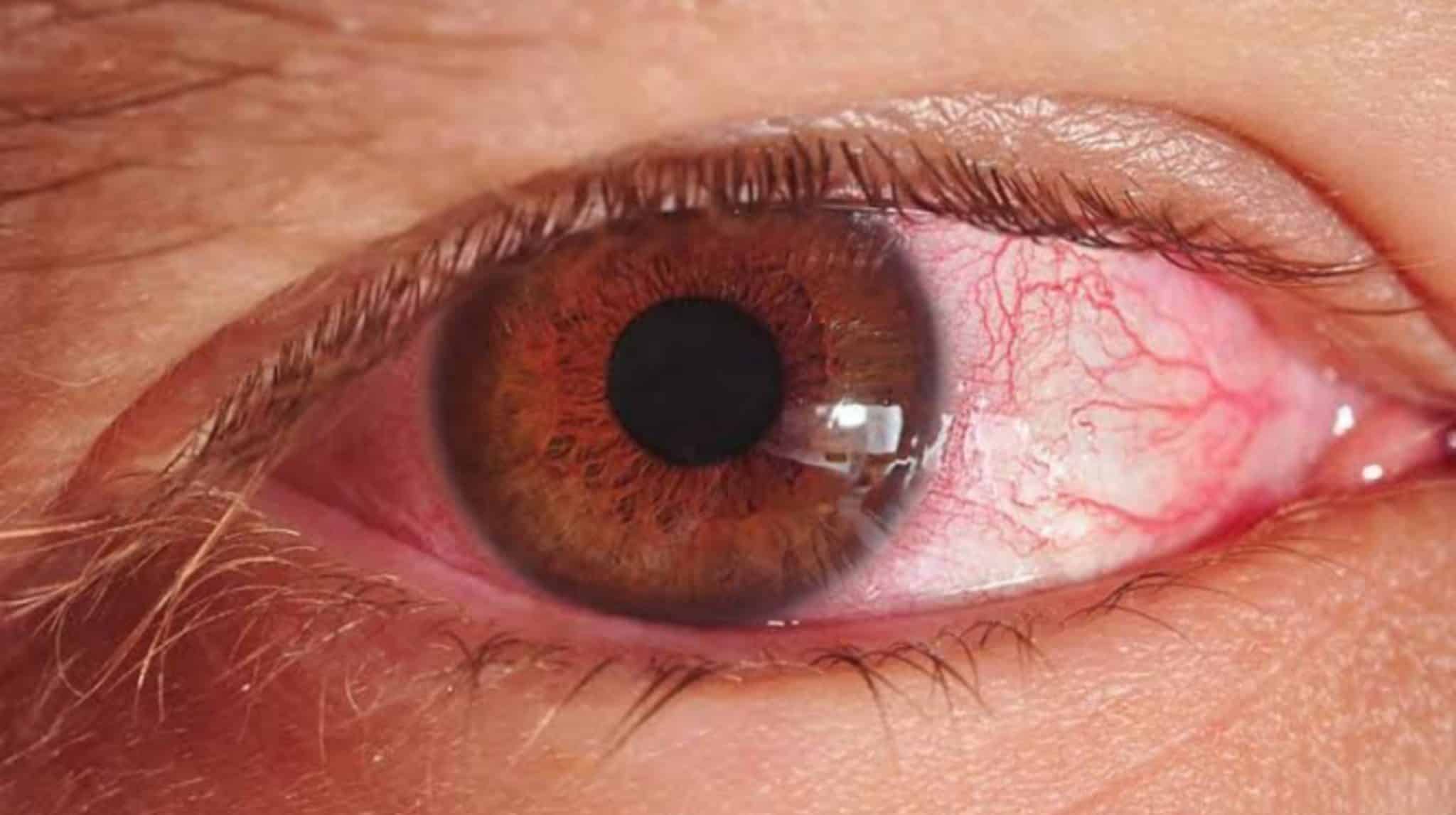 Sindh Issues Warning to Control Pink Eye Infection Outbreak in Karachi