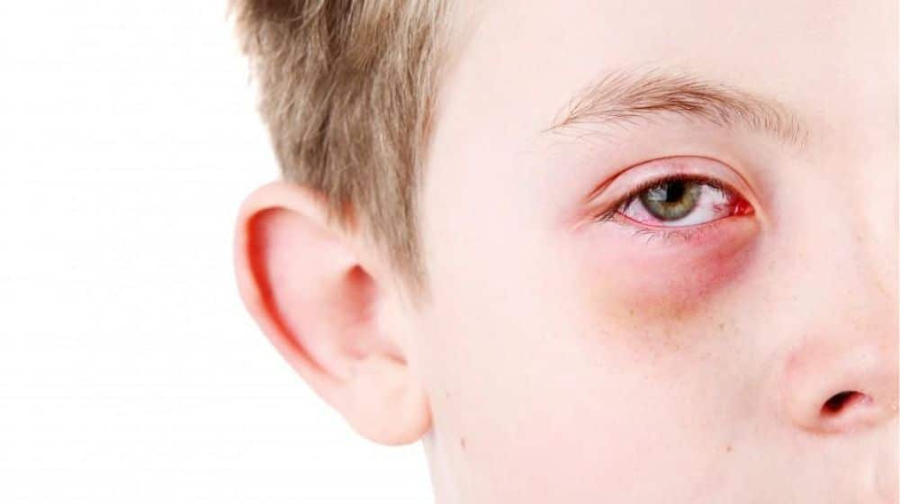 Punjab Announces Holiday for Schools Amid Pink Eye Outbreak