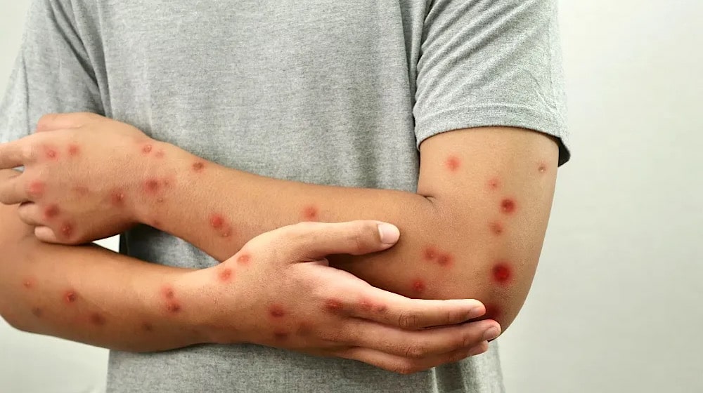 Measles Outbreak Claims Lives of 14 Children in Punjab