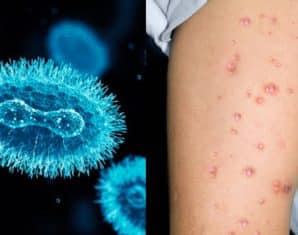 mpox