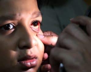 punjab pink eye