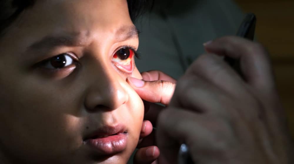punjab pink eye